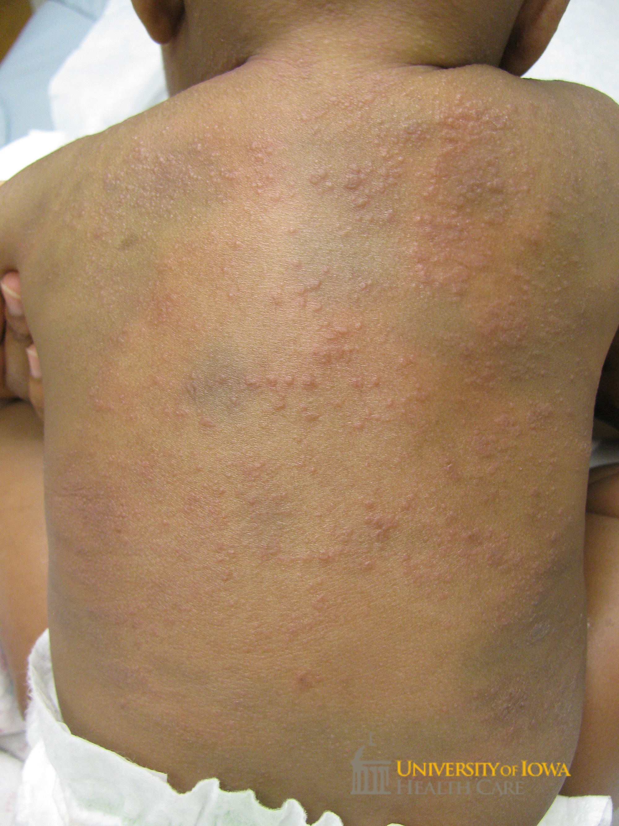 Erythematous papules on the back. (click images for higher resolution).